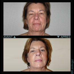 Chirurgie esthtique de rajeunissement du visage : lifting 