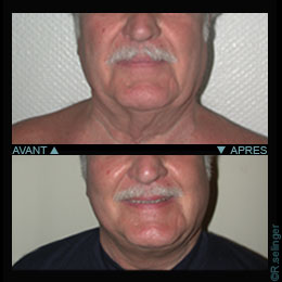 Chirurgie esthtique de rajeunissement du visage : lifting 