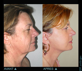 Chirurgie esthtique du visage : lifting du cou et de la face